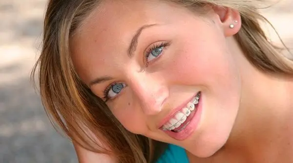 ortodoncia-chica