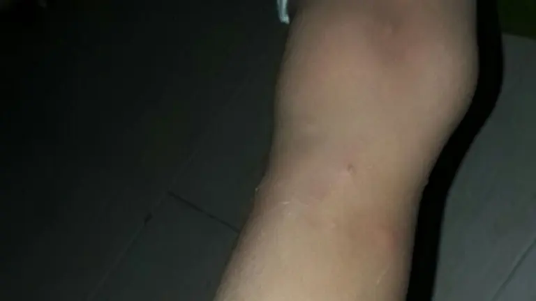 Un brazo de un menor con picaduras de los &aacute;caros