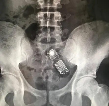 Telefono en miniatura en el interior del organismo de un preso