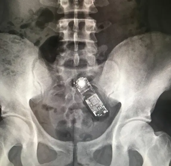 Telefono en miniatura en el interior del organismo de un preso